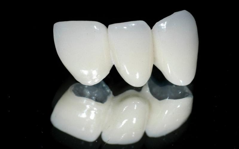 Cầu răng sứ Titan có tốt không?