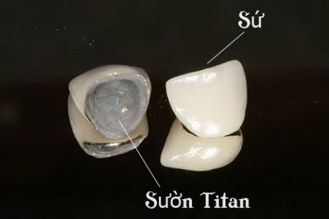 Cách bảo quản răng sứ Titan như thế nào để giữ độ bền?