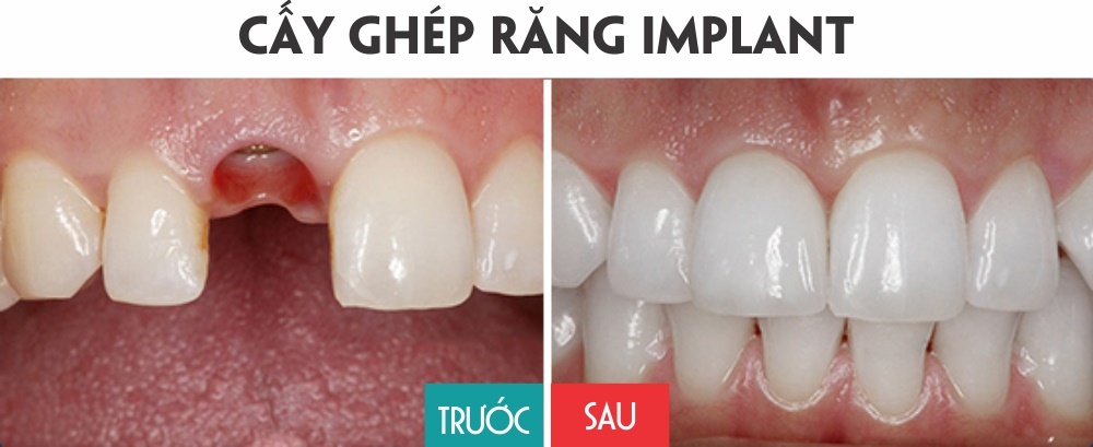 Những lợi ích tuyệt vời của phương pháp cấy ghép implant