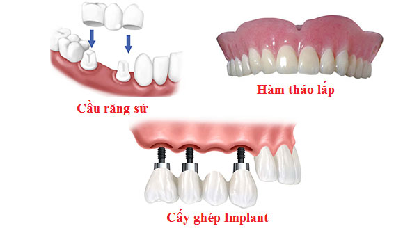 Những điều cần biết trước khi trồng răng giả