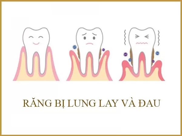 Răng lung lay có bọc sứ được không?