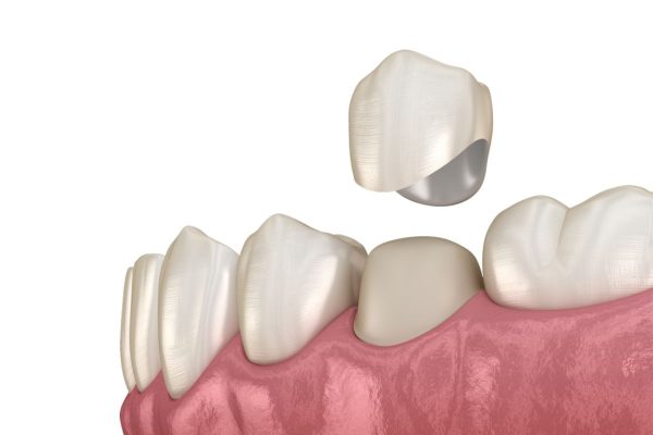 Có nên bọc răng sứ nguyên hàm không?