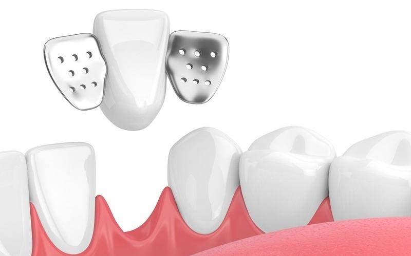 Cầu răng sứ là gì? Làm cầu răng sứ có bền không? Bọc Răng Sứ Cần Thơ