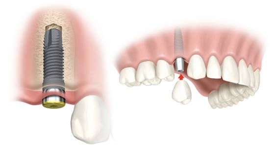 Bảng giá cấy implant tại Nha khoa Cần Thơ Ts Lâm