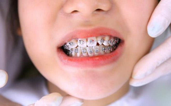 Thời điểm lý tưởng để niềng răng cho trẻ em | Nha khoa trẻ em Cần Thơ