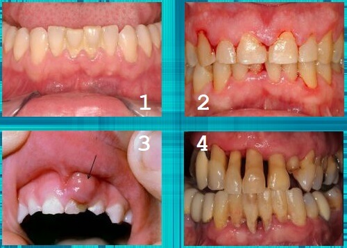 Các loại bệnh viêm nha chu trẻ em | Nha Khoa Cần Thơ Ts Lâm