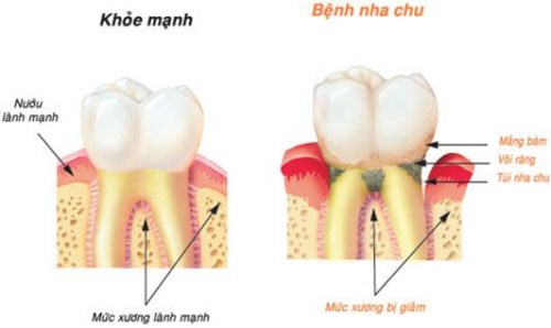 Bệnh Nha Chu Có Lây Truyền | Điều Trị Nha Chu Cần Thơ