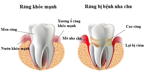 Dấu hiệu nhận biết viêm nha chu ở trẻ | Nha Khoa Cần Thơ Ts Lâm