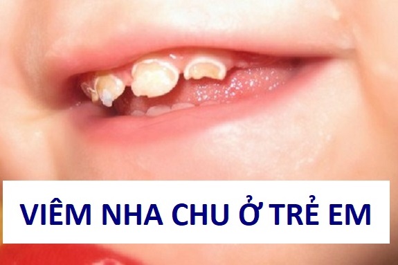 Tác hại viêm nha chu ở Trẻ em | Nha Khoa Cần Thơ Ts Lâm