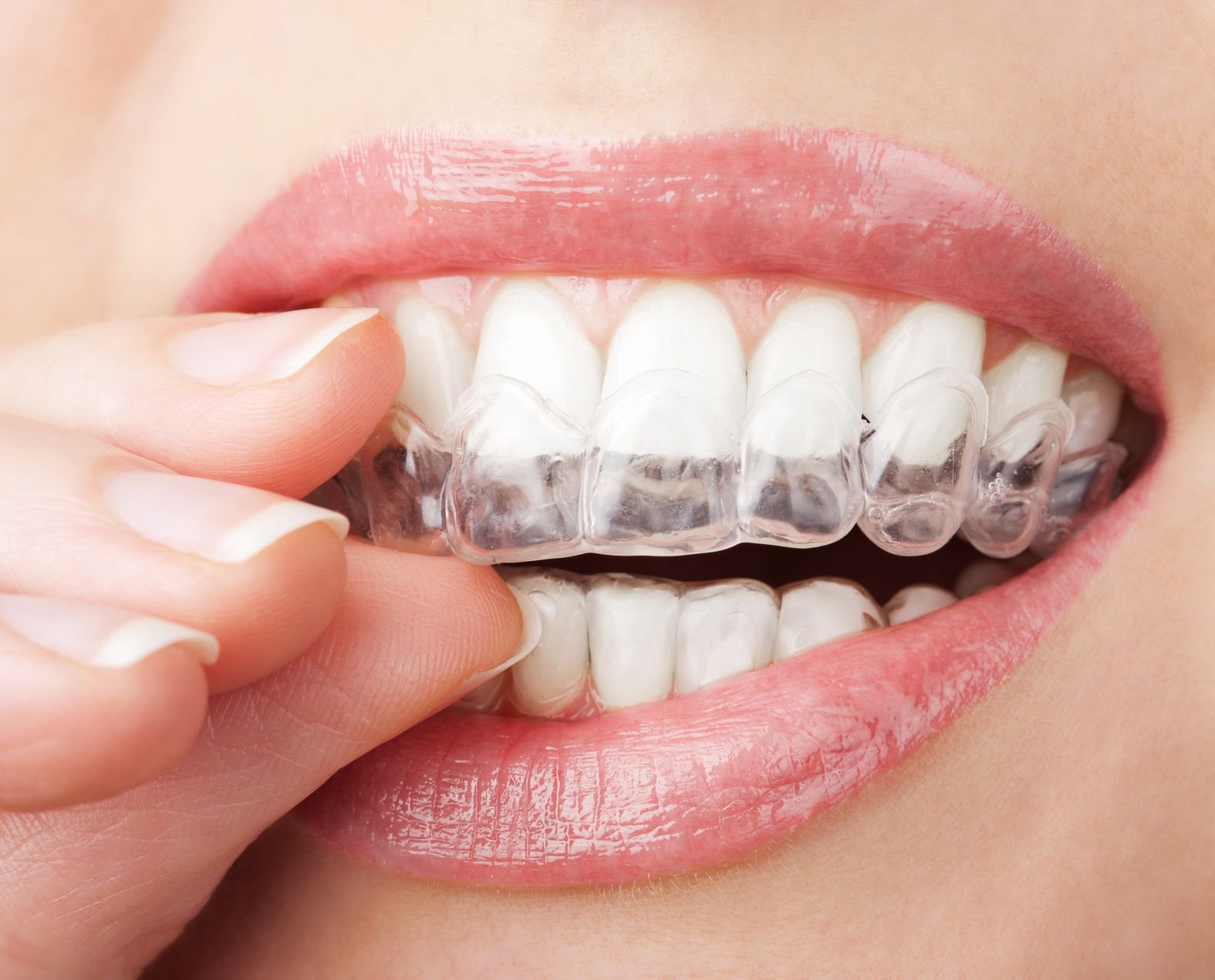 Niềng răng trong suốt invisalign và những điều cần biết | Niềng răng Cần Thơ