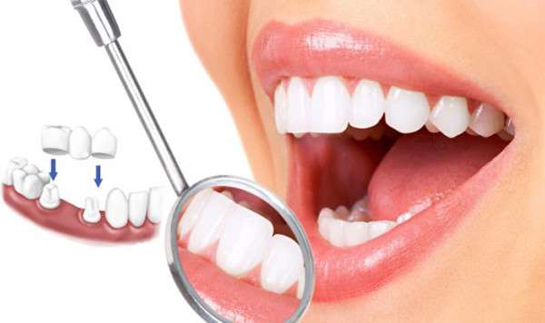 Trồng răng Implant mất thời gian bao lâu? Implant Cần Thơ