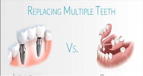 So Sánh Phương Pháp Trồng Răng Giả Tháo Lắp Và Trồng Răng Implant | Implant Cần ...