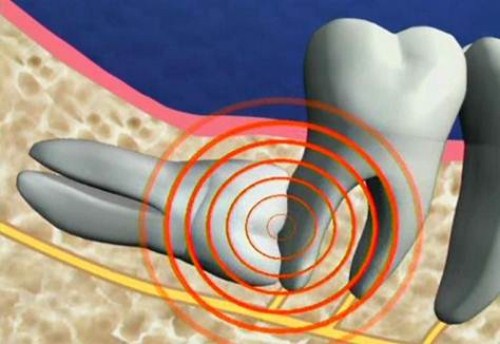 Sao cần phải nhổ răng số 8 | Nhổ Răng Cần Thơ