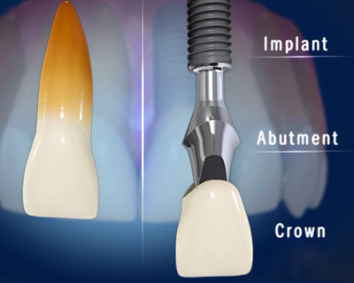 Cấy Ghép Implant Ở Cần Thơ