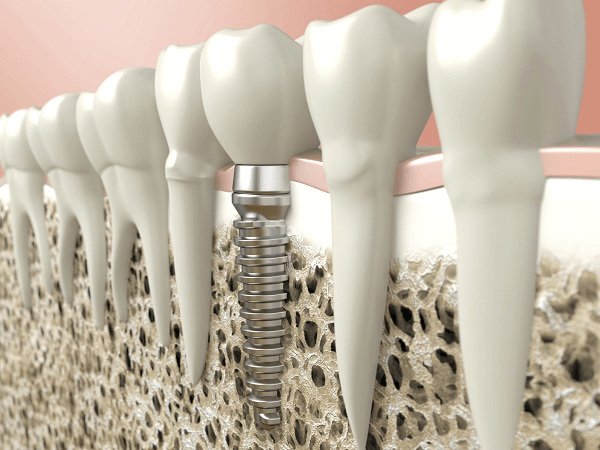 Địa Chỉ Cấy Ghép Implant Tốt Nhất Cần Thơ