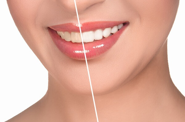 Tẩy trắng răng có ảnh hưởng gì đến răng không? Tẩy trắng răng Cần Thơ
