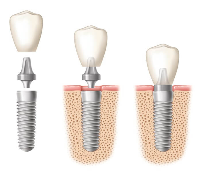 10 lợi ích của việc cấy ghép implant - implant Cần Thơ