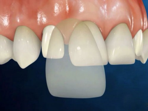 Răng Sứ Cần Thơ | Những Vấn Đề Thường Gặp Sau Khi Trồng Răng Sứ